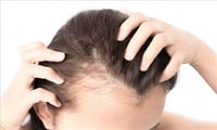 Having Vitamin D deficiency leads to Hair loss 